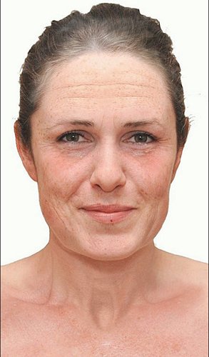 Pigment- és májfoltok keletkeznek a bőr felületén. Fotó: Daily Mail